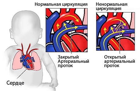 Открытый и закрытый артериальный проток 